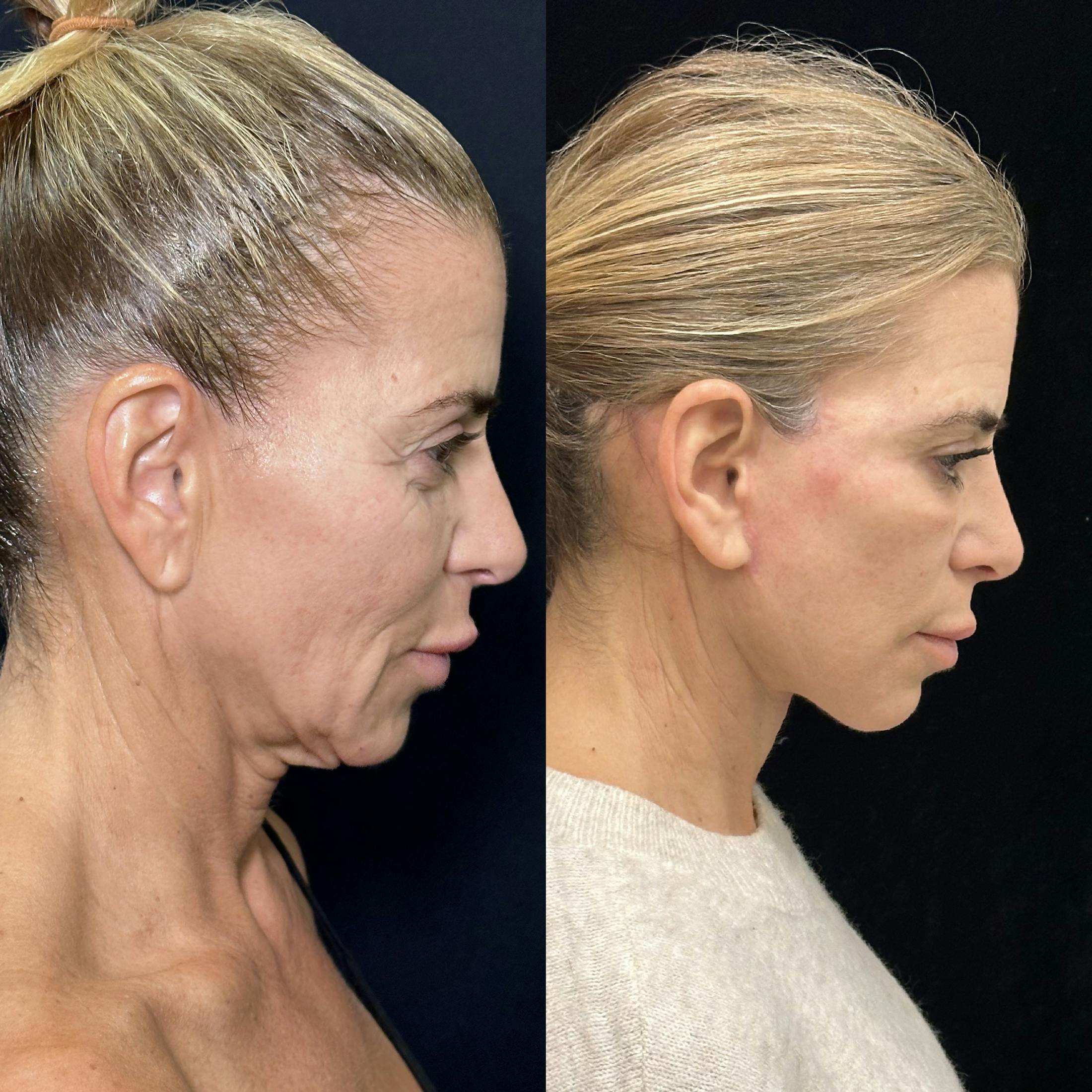 Deep Plane Facelift Before & After Gallery - Patient 274368 - Image 2