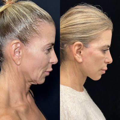 Deep Plane Facelift Before & After Gallery - Patient 274368 - Image 2