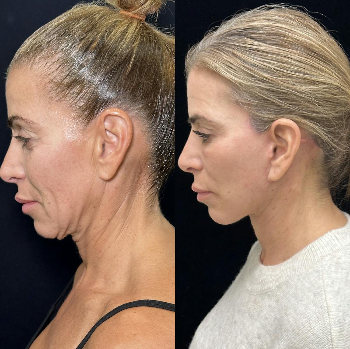 Deep Plane Facelift Before & After Gallery - Patient 274368 - Image 4