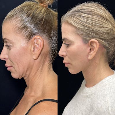 Deep Plane Facelift Before & After Gallery - Patient 274368 - Image 4