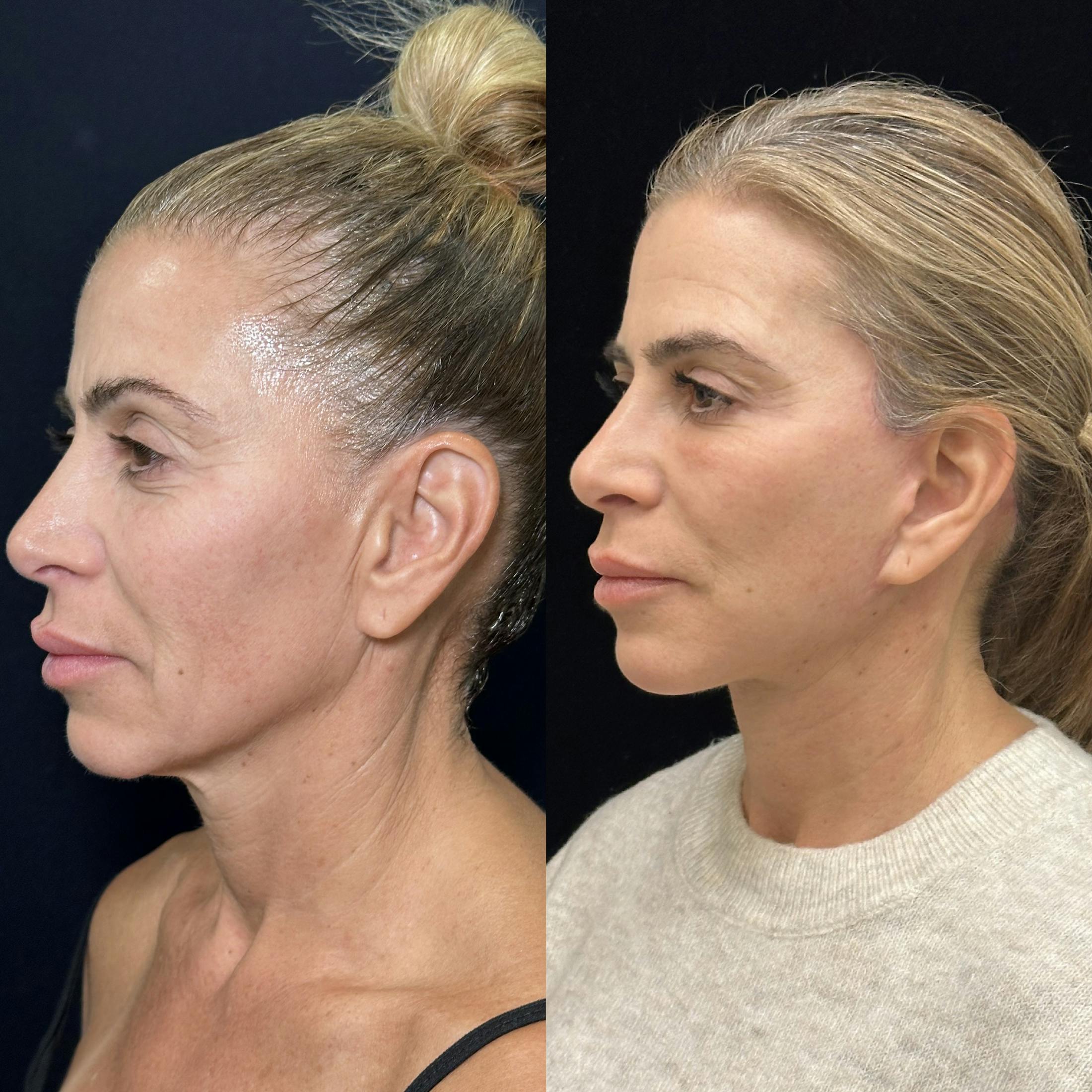 Deep Plane Facelift Before & After Gallery - Patient 274368 - Image 3