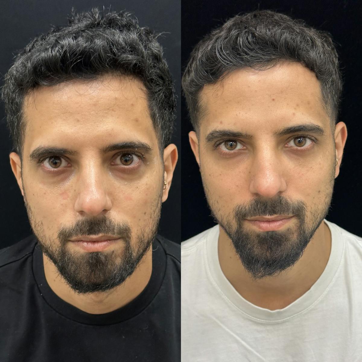 Facial Fat Transfer Before & After Gallery - Patient 308444 - Image 1