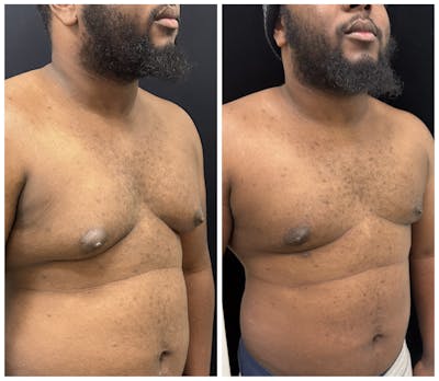 Gynecomastia Before & After Gallery - Patient 188235 - Image 2