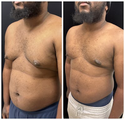 Gynecomastia Before & After Gallery - Patient 188235 - Image 3