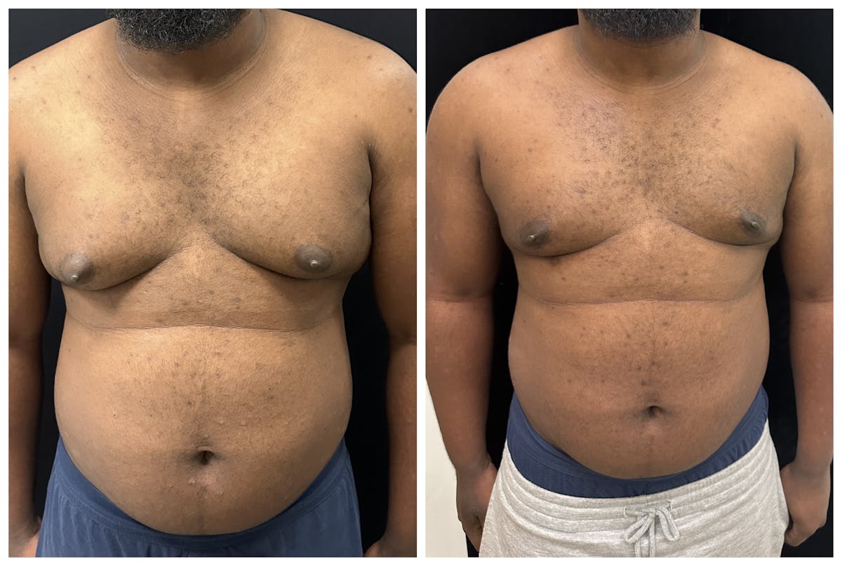 Gynecomastia Before & After Gallery - Patient 188235 - Image 1