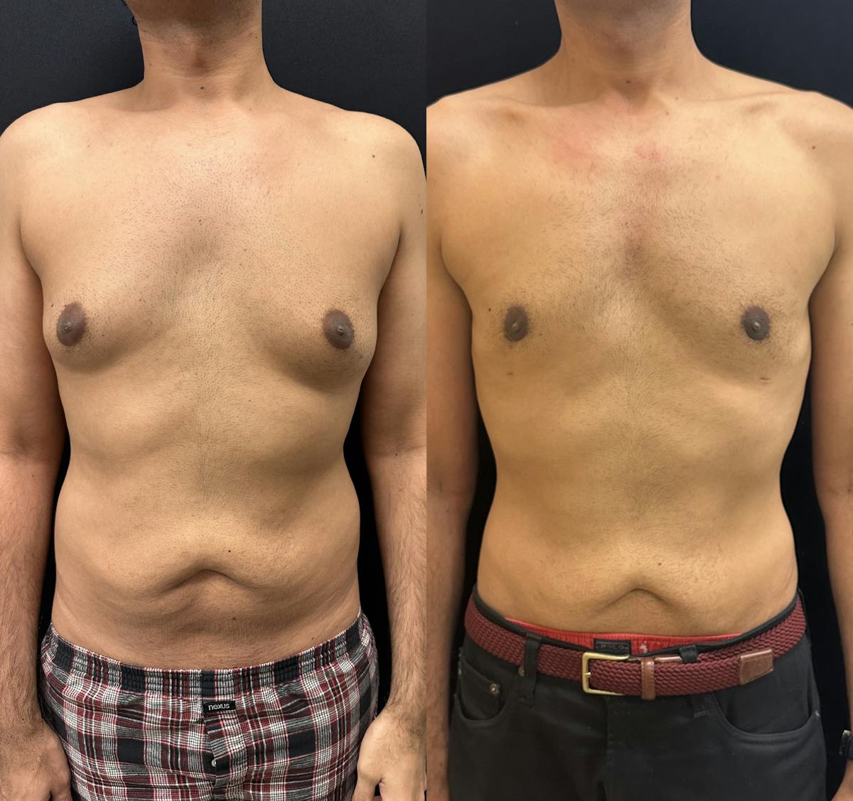 Gynecomastia Before & After Gallery - Patient 126719 - Image 1