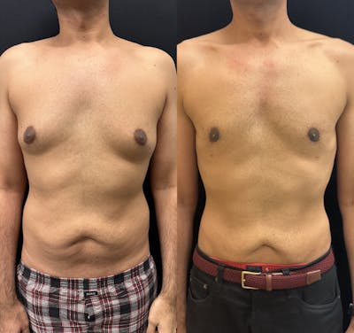 Gynecomastia Before & After Gallery - Patient 126719 - Image 1