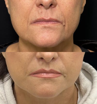 Lip Lift Before & After Gallery - Patient 110445 - Image 1