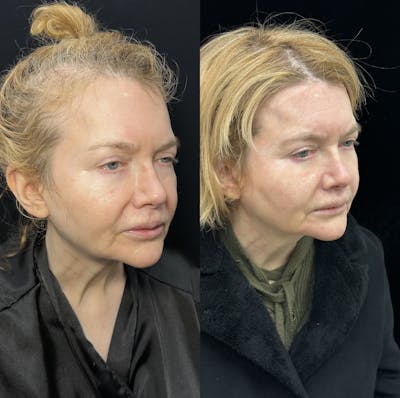 Lip Lift Before & After Gallery - Patient 283191 - Image 2