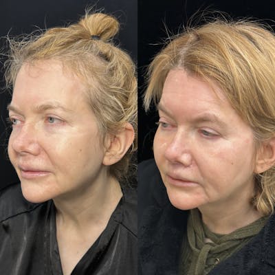 Lip Lift Before & After Gallery - Patient 283191 - Image 3