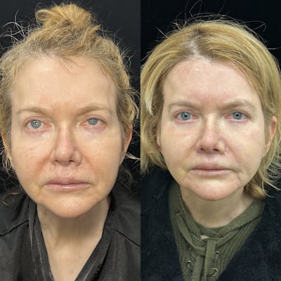 Lip Lift Before & After Gallery - Patient 283191 - Image 1