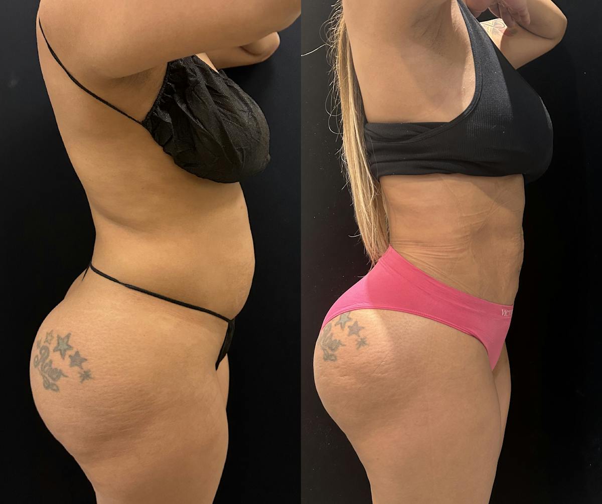Liposuction Before & After Gallery - Patient 147485 - Image 2