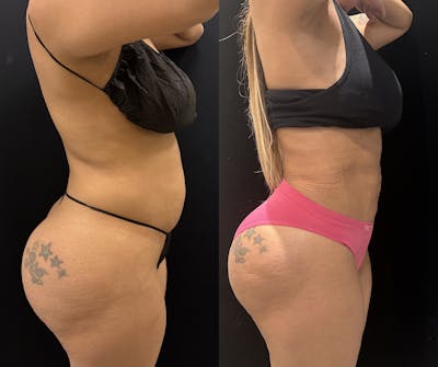 Liposuction Before & After Gallery - Patient 147485 - Image 2