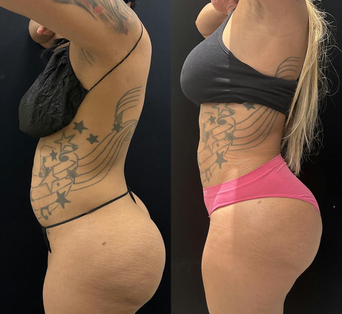 Liposuction Before & After Gallery - Patient 147485 - Image 3