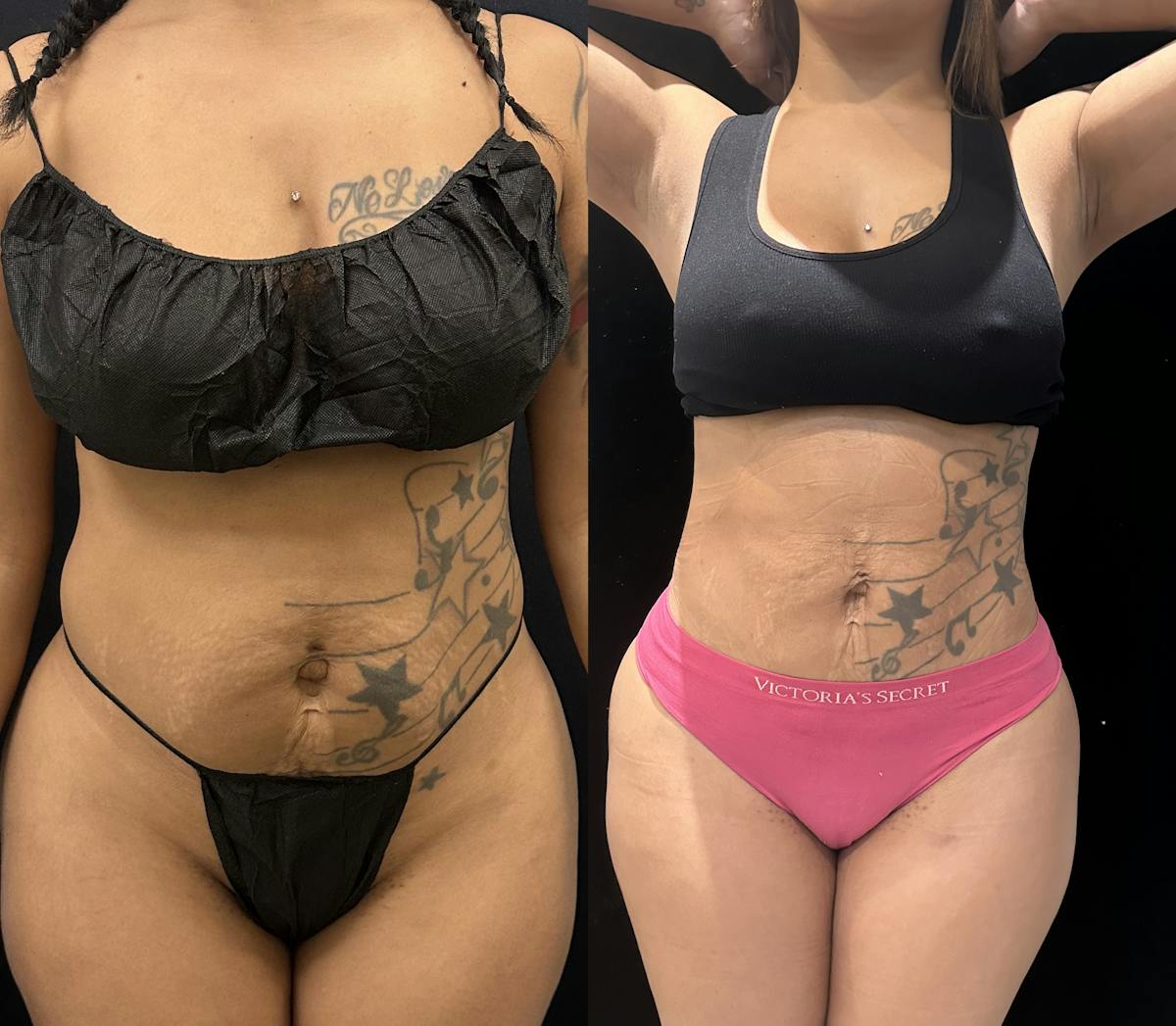 Liposuction Before & After Gallery - Patient 147485 - Image 1