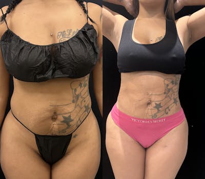 Liposuction Before & After Gallery - Patient 147485 - Image 1