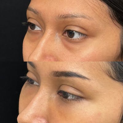 Lower Blepharoplasty Before & After Gallery - Patient 181898 - Image 1