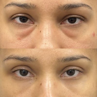 Lower Blepharoplasty Before & After Gallery - Patient 269725 - Image 1