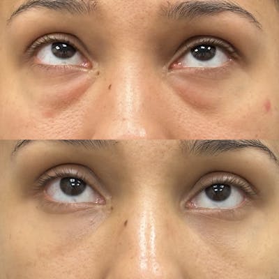 Lower Blepharoplasty Before & After Gallery - Patient 269725 - Image 2