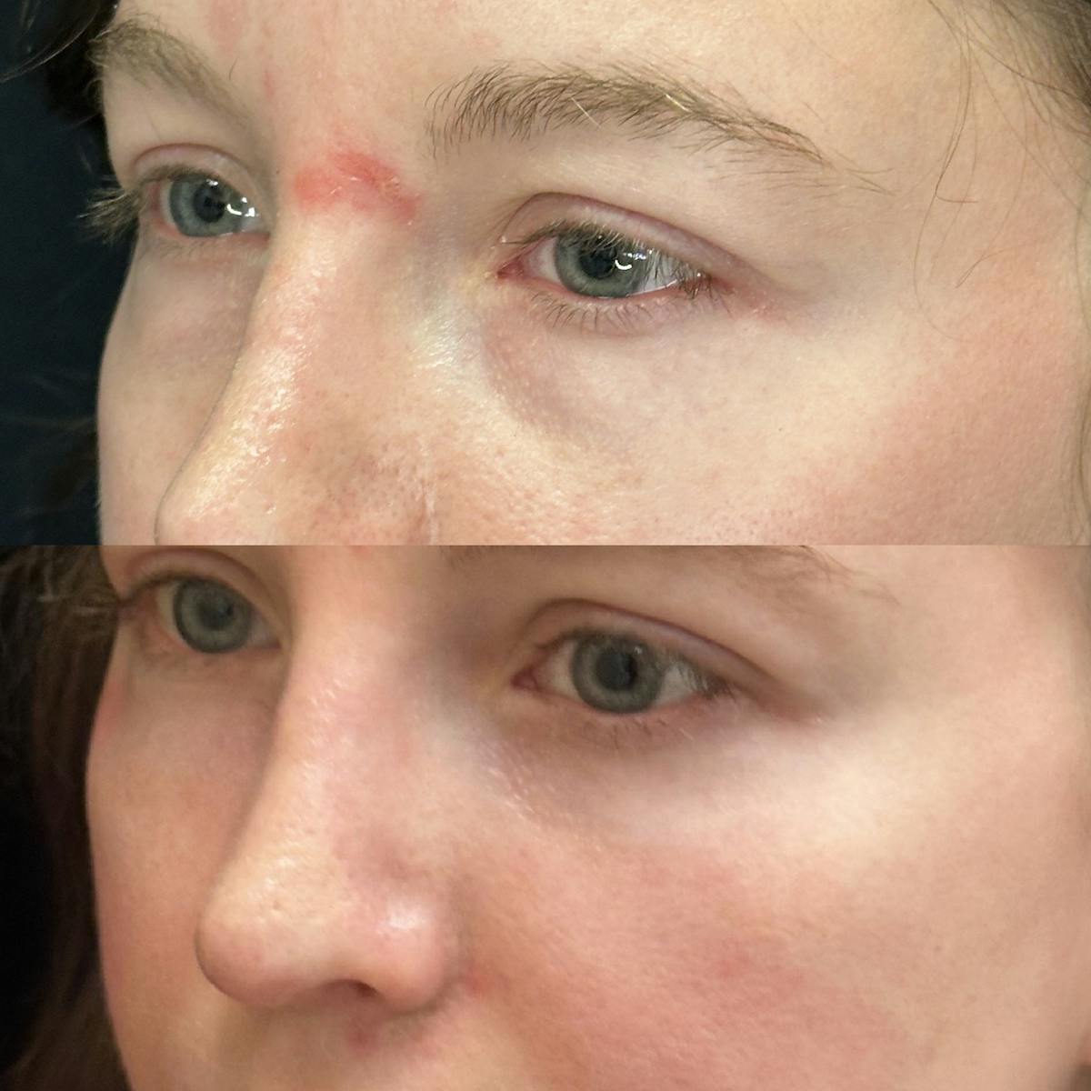 Lower Blepharoplasty Before & After Gallery - Patient 275454 - Image 3