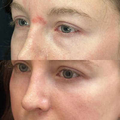 Lower Blepharoplasty Before & After Gallery - Patient 275454 - Image 3