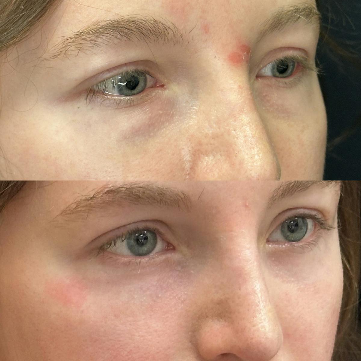 Lower Blepharoplasty Before & After Gallery - Patient 275454 - Image 2