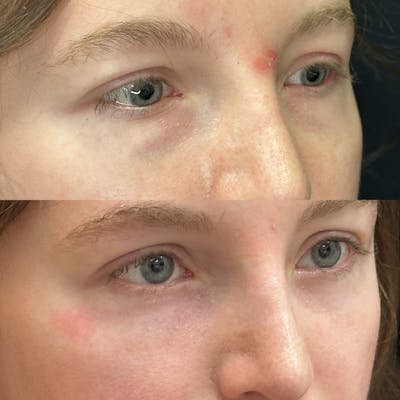 Lower Blepharoplasty Before & After Gallery - Patient 275454 - Image 2
