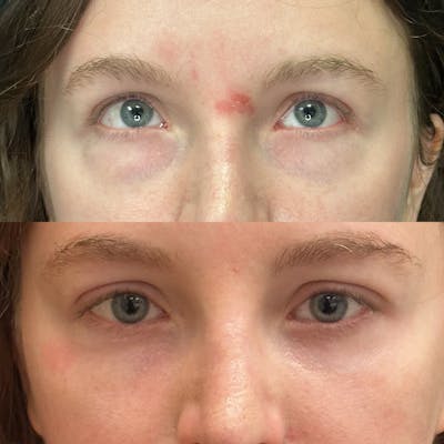 Lower Blepharoplasty Before & After Gallery - Patient 275454 - Image 1
