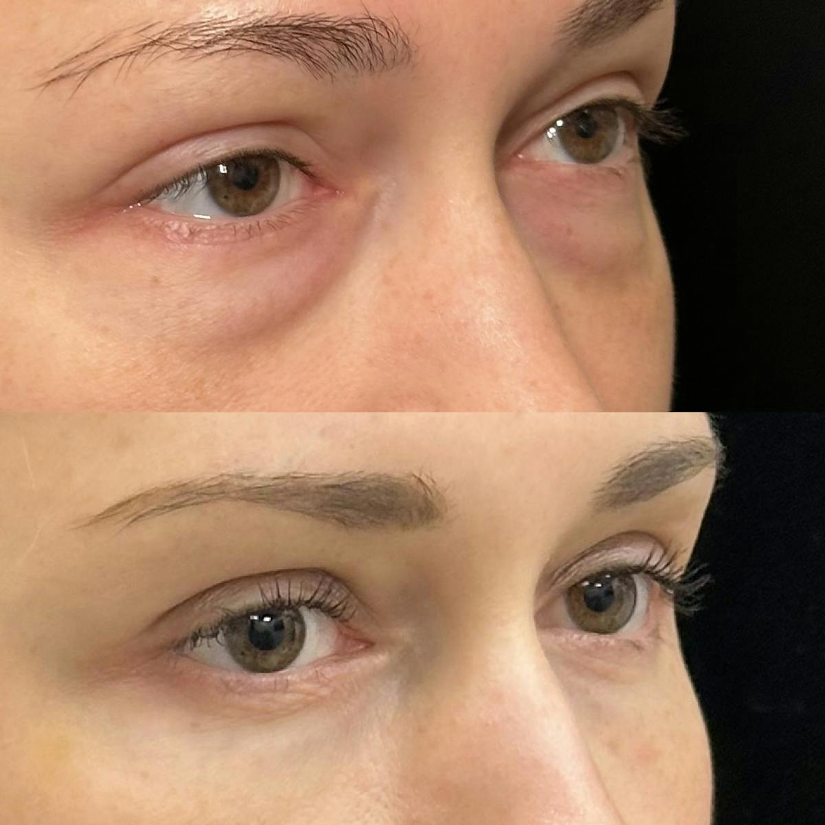 Lower Blepharoplasty Before & After Gallery - Patient 211522 - Image 3