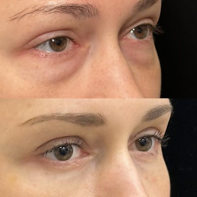 Lower Blepharoplasty Before & After Gallery - Patient 211522 - Image 3