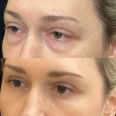 Lower Blepharoplasty Before & After Gallery - Patient 211522 - Image 4
