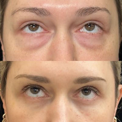 Lower Blepharoplasty Before & After Gallery - Patient 211522 - Image 2