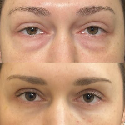 Lower Blepharoplasty Before & After Gallery - Patient 211522 - Image 1