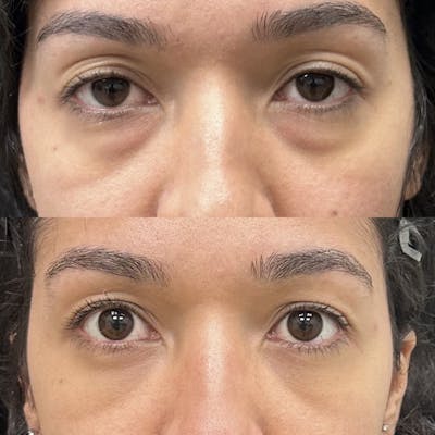 Lower Blepharoplasty Before & After Gallery - Patient 206913 - Image 1