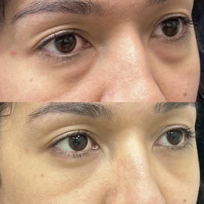 Lower Blepharoplasty Before & After Gallery - Patient 206913 - Image 3