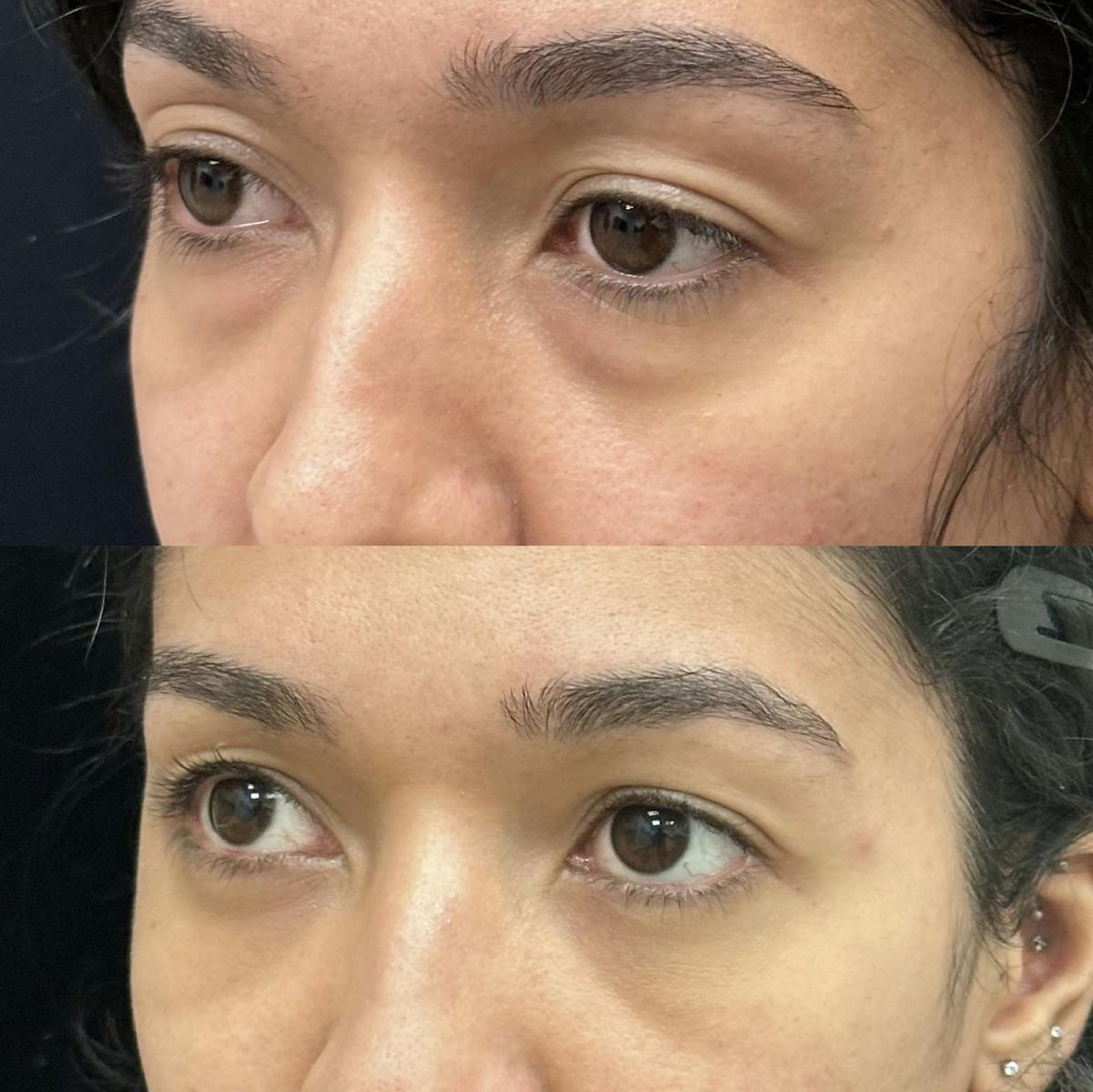 Lower Blepharoplasty Before & After Gallery - Patient 206913 - Image 4