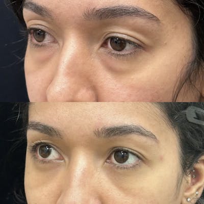Lower Blepharoplasty Before & After Gallery - Patient 206913 - Image 4
