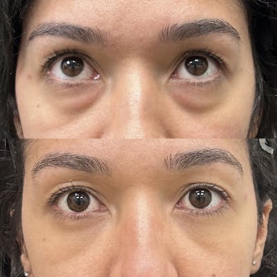 Lower Blepharoplasty Before & After Gallery - Patient 206913 - Image 2