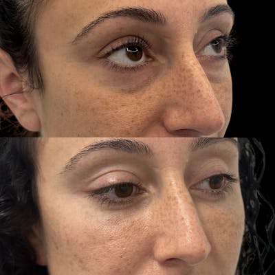 Lower Blepharoplasty Before & After Gallery - Patient 364585 - Image 3