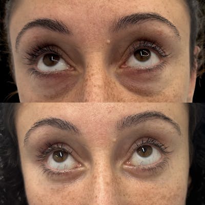 Lower Blepharoplasty Before & After Gallery - Patient 364585 - Image 2