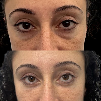 Lower Blepharoplasty Before & After Gallery - Patient 364585 - Image 1