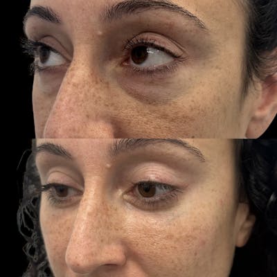 Lower Blepharoplasty Before & After Gallery - Patient 364585 - Image 4
