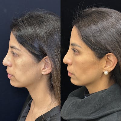 Lower Blepharoplasty Before & After Gallery - Patient 176994 - Image 5