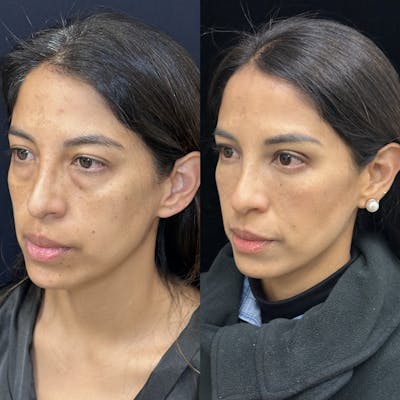 Lower Blepharoplasty Before & After Gallery - Patient 176994 - Image 4