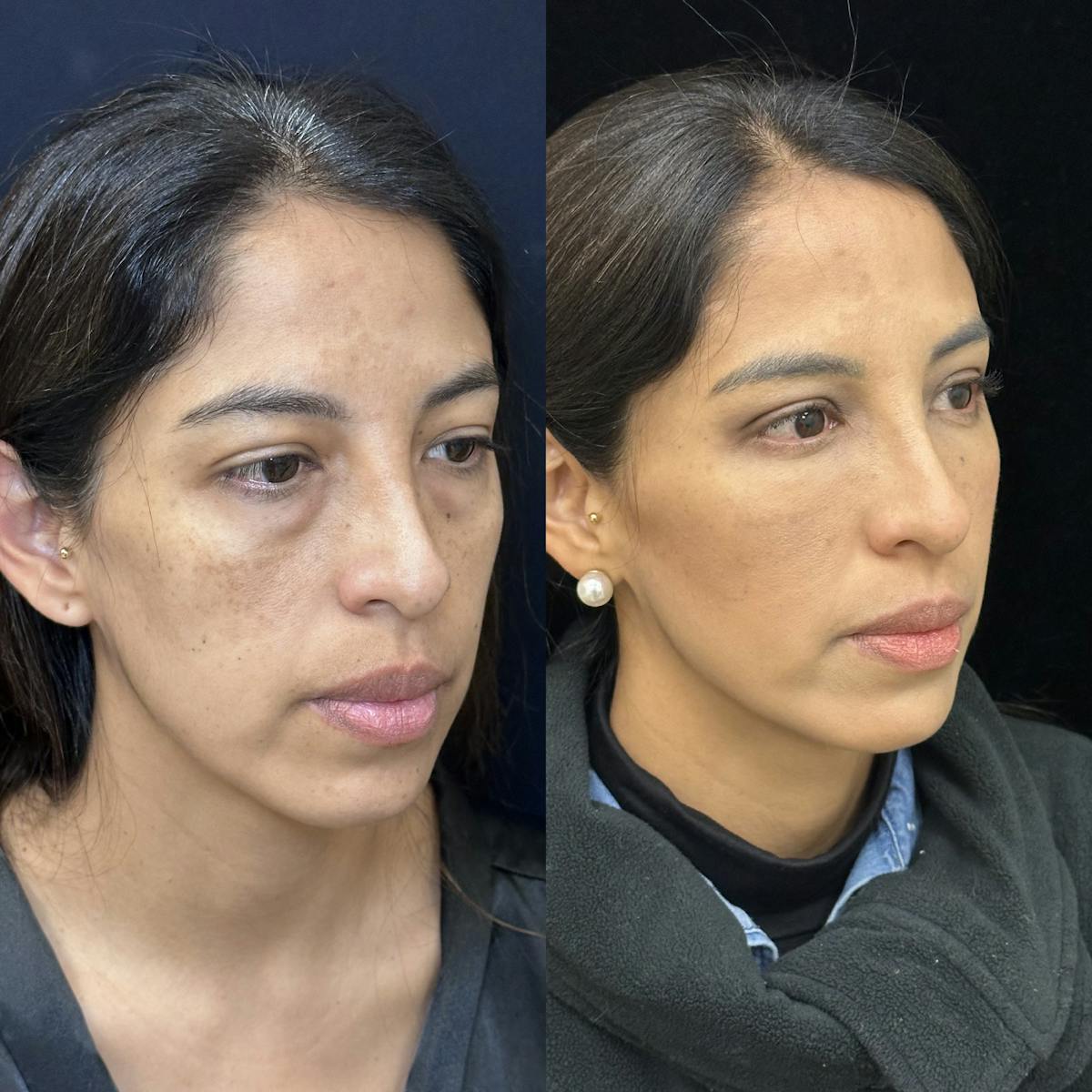 Lower Blepharoplasty Before & After Gallery - Patient 176994 - Image 6