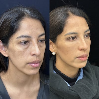 Lower Blepharoplasty Before & After Gallery - Patient 176994 - Image 6