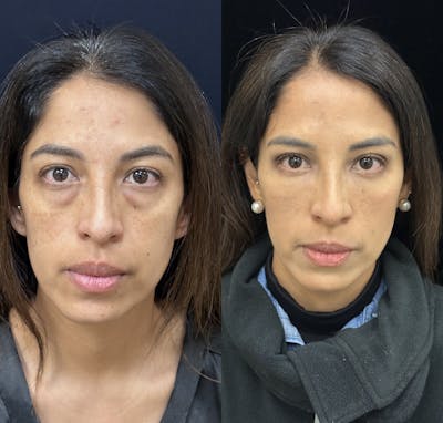 Lower Blepharoplasty Before & After Gallery - Patient 176994 - Image 2