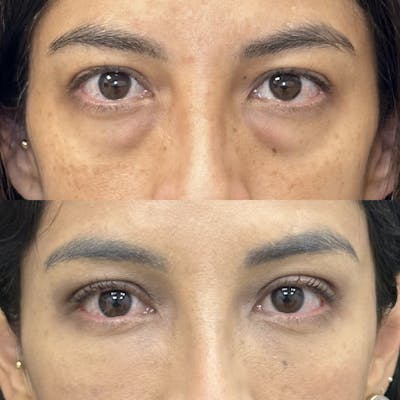 Lower Blepharoplasty Before & After Gallery - Patient 176994 - Image 1