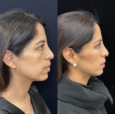 Lower Blepharoplasty Before & After Gallery - Patient 176994 - Image 7