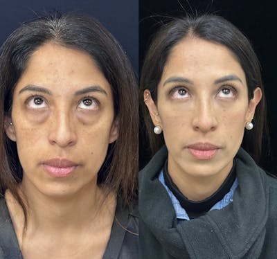 Lower Blepharoplasty Before & After Gallery - Patient 176994 - Image 3